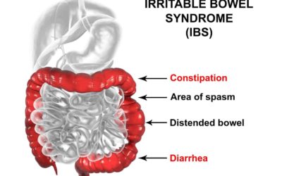 How to Deal with IBS